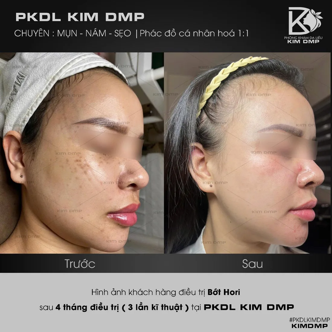 Hình ảnh trước và sau khi chăm sóc bớt hori tại phòng khám da liễu Kim DMP Gò Vấp