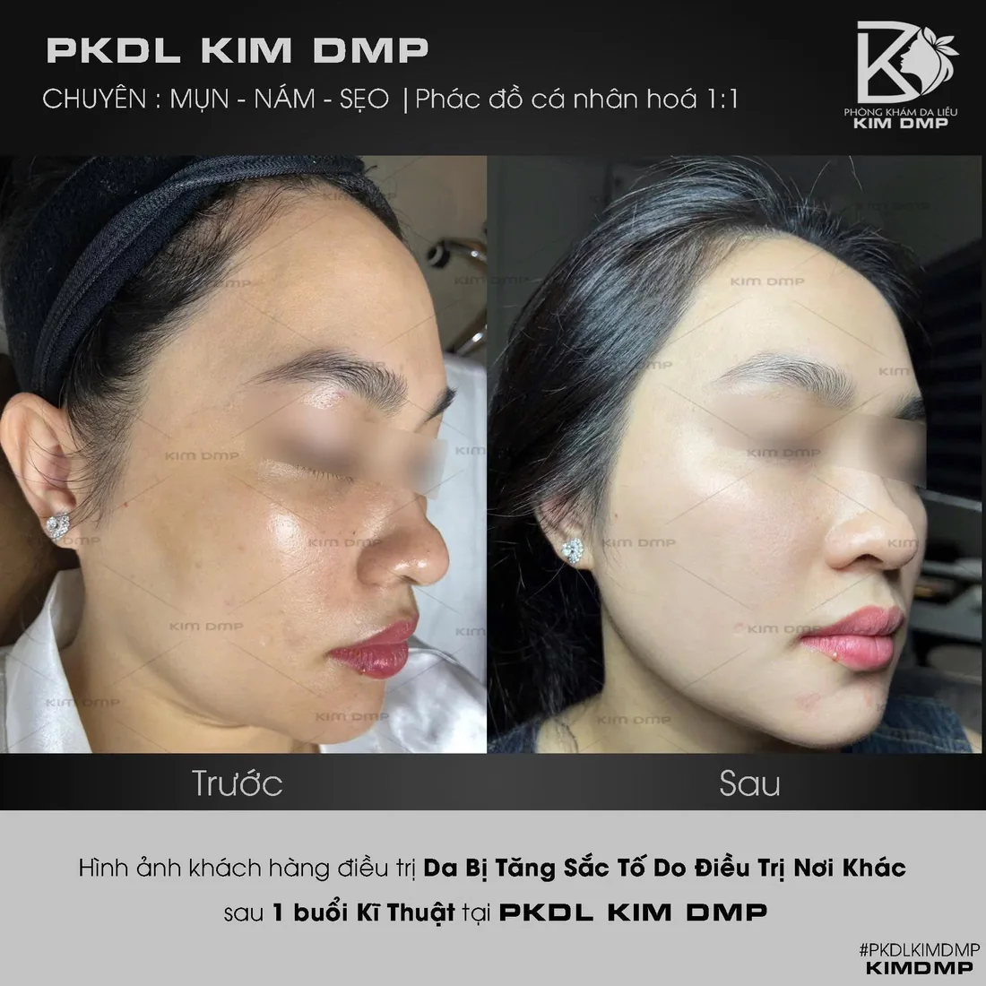 Hình ảnh trước và sau khi chăm sóc da bị tăng sắc tố sau khi làm ở nơi khác tại phòng khám da liễu Kim DMP Gò Vấp