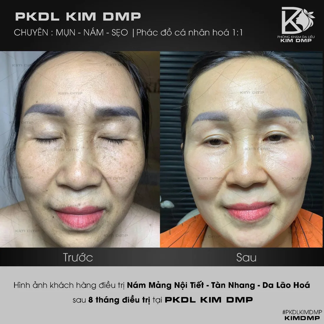 Hình ảnh trước và sau khi chăm sóc nám mảng nội tiết, tàn nhang và da lão hóa tại Kim DMP Gò Vấp