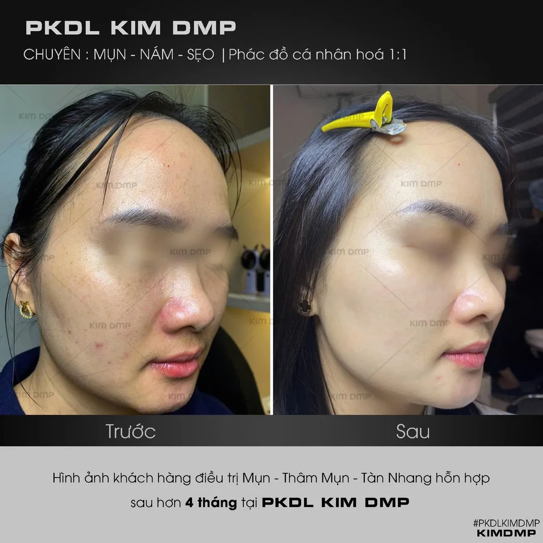 Hình ảnh trước và sau khi chăm sóc mụn, thâm mụn và tàn nhang hỗn hợp tại phòng khám da liễu Kim DMP Gò Vấp
