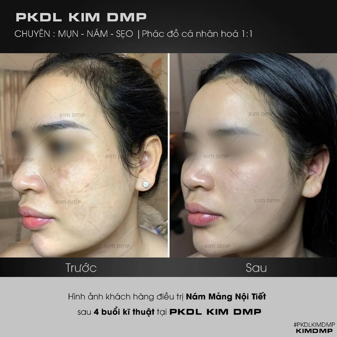 Hình ảnh trước và sau khi chăm sóc nám mảng nội tiết tại phòng khám da liễu Kim DMP Gò Vấp