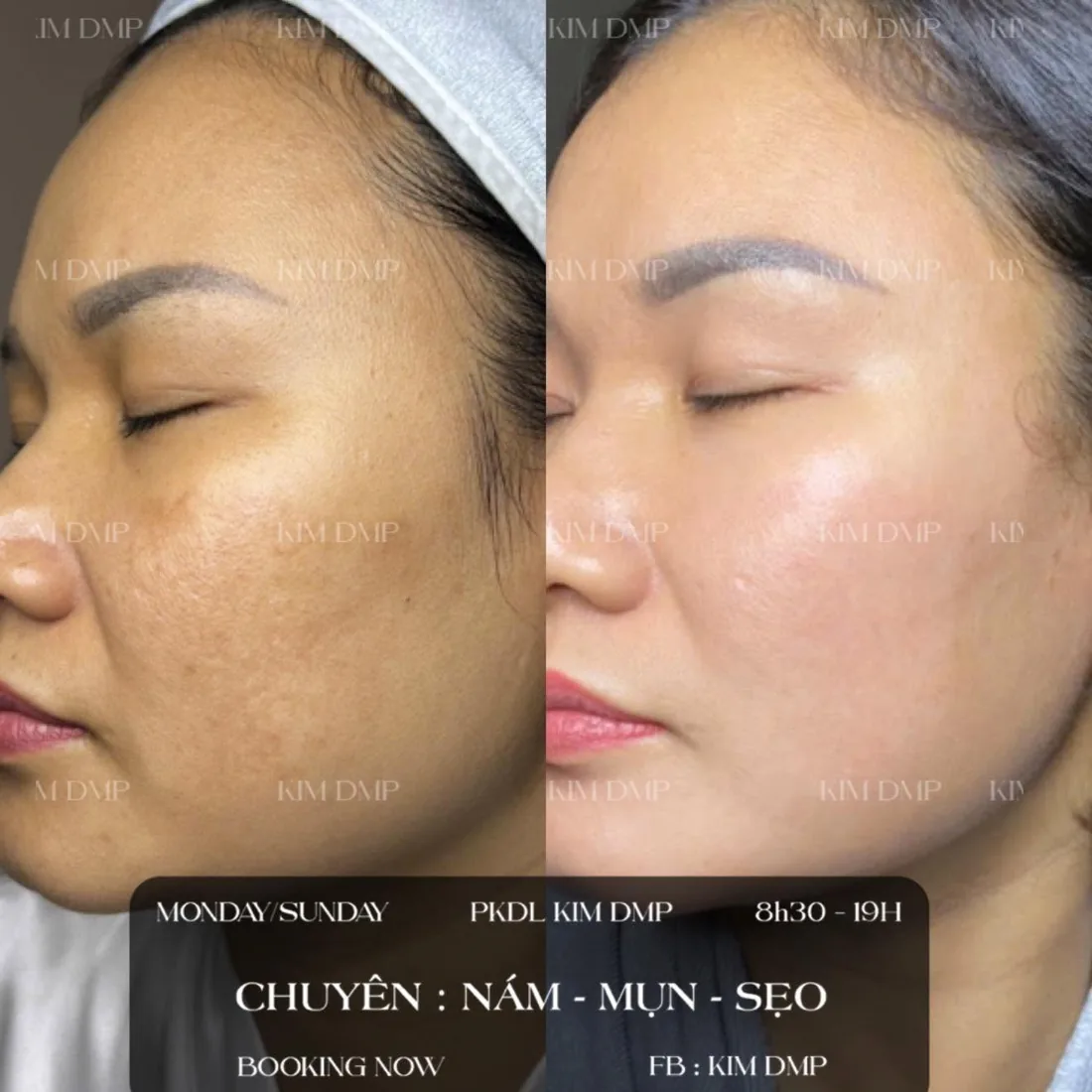 Hình ảnh trước và sau khi chăm sóc nám, mụn và sẹo tại phòng khám da liễu Kim DMP Gò Vấp