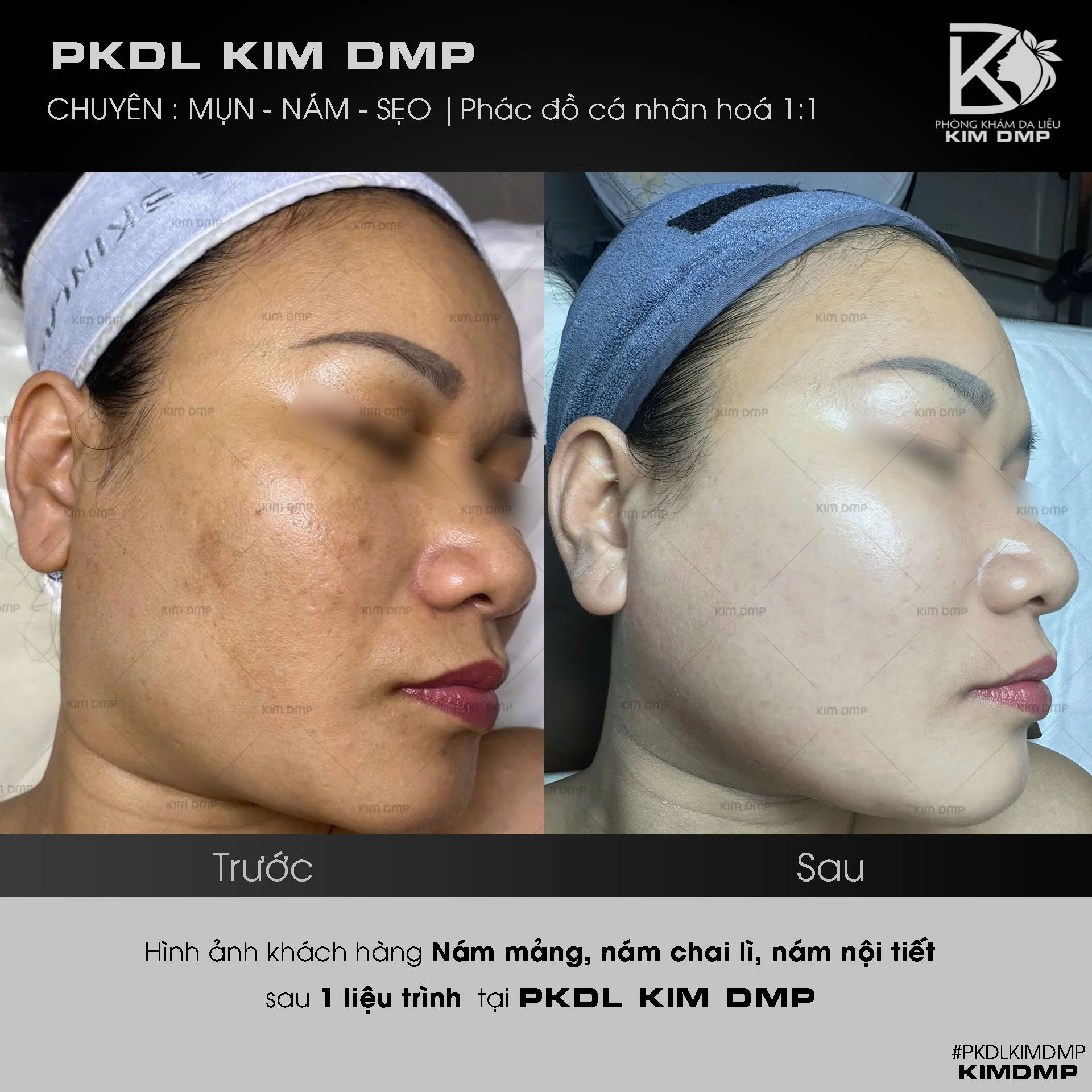 Hình ảnh trước và sau khi chăm sóc nám mảng, nám chai lì và nám nội tiết tại phòng khám da liễu Kim DMP Gò Vấp