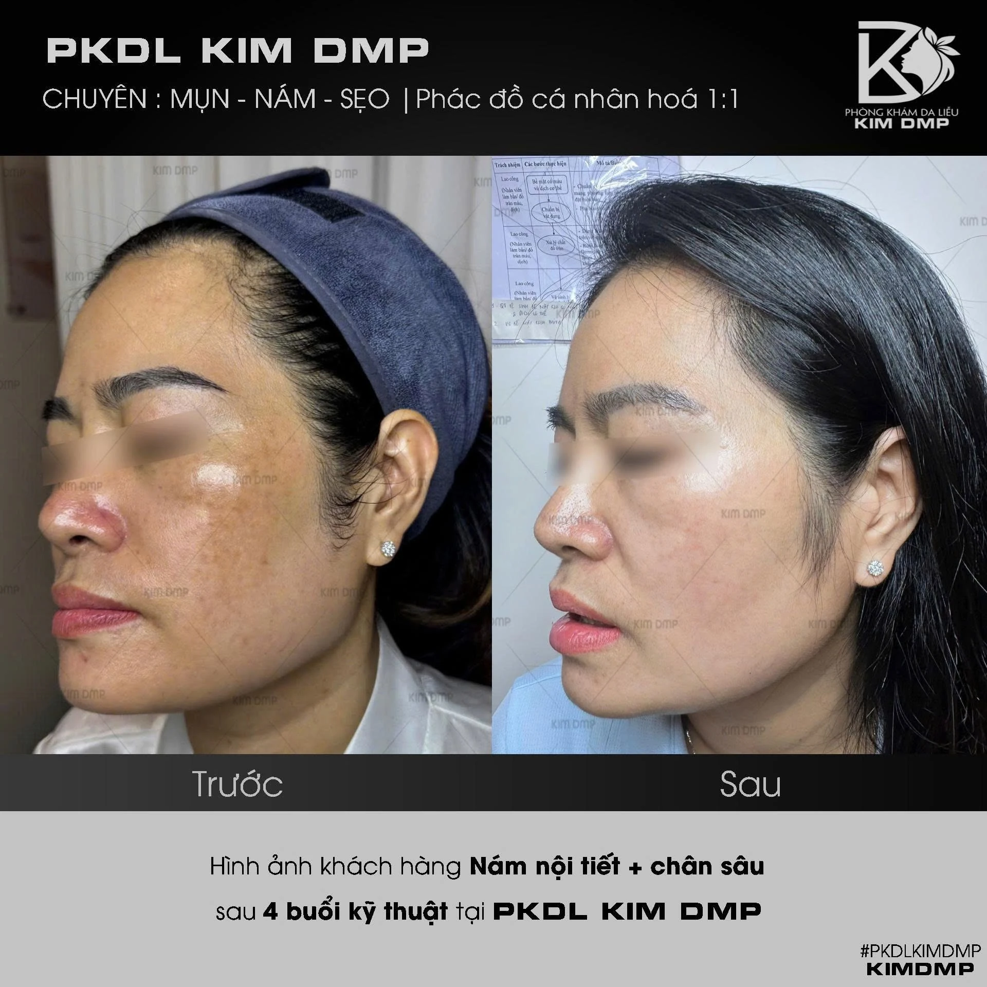 Hình ảnh trước và sau khi chăm sóc nám nội tiết và nám chân sâu tại phòng khám da liễu Kim DMP Gò Vấp