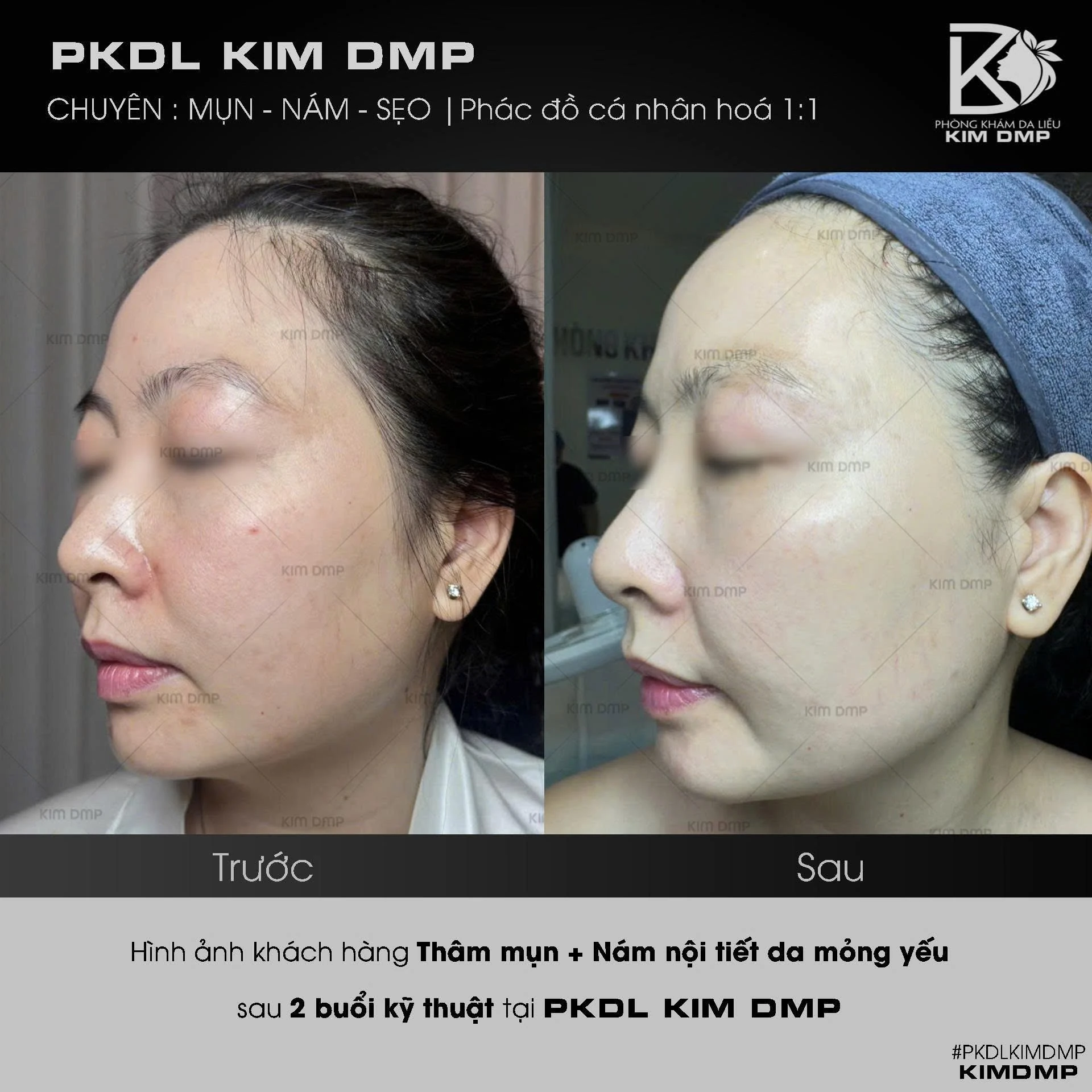 Hình ảnh trước và sau khi chăm sóc thâm mụn và nám nội tiết trên nền da mỏng yếu tại phòng khám da liễu Kim DMP Gò Vấp
